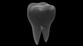 Global D lance le plus petit implant dentaire du monde