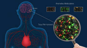 Medimprint avance dans sa lutte contre le cancer du cerveau