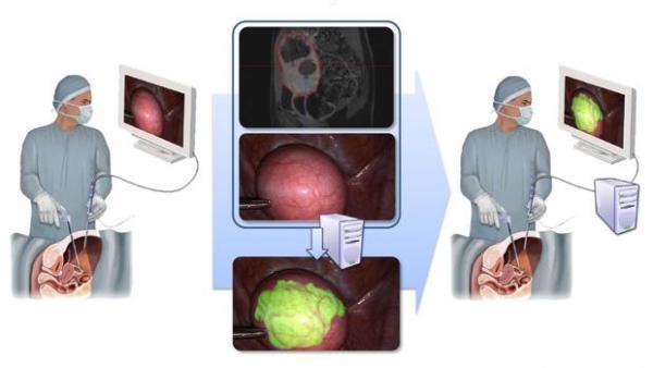 SurgAR vise le podium de la réalité augmentée en chirurgie mini-invasive